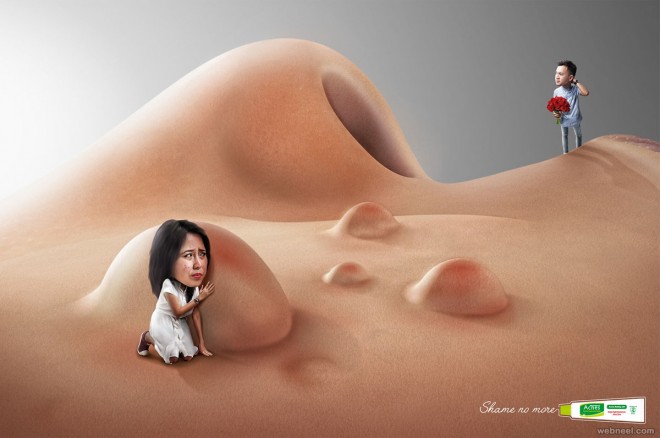 pimples cream print advertisement by rino rinanditio